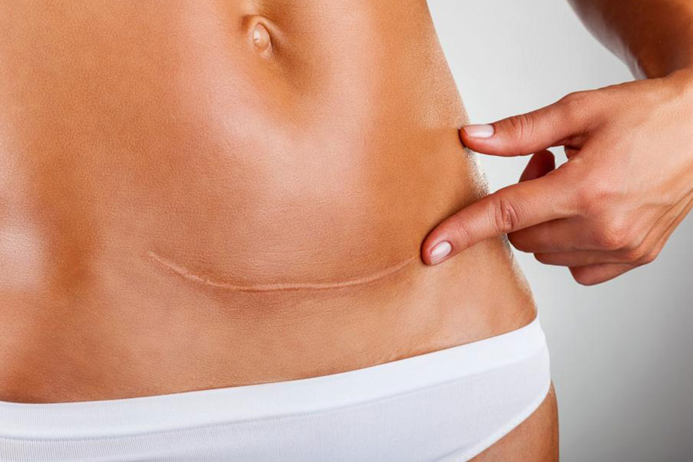 Common Symptoms and Risk Factors of Ovarian Cancer
