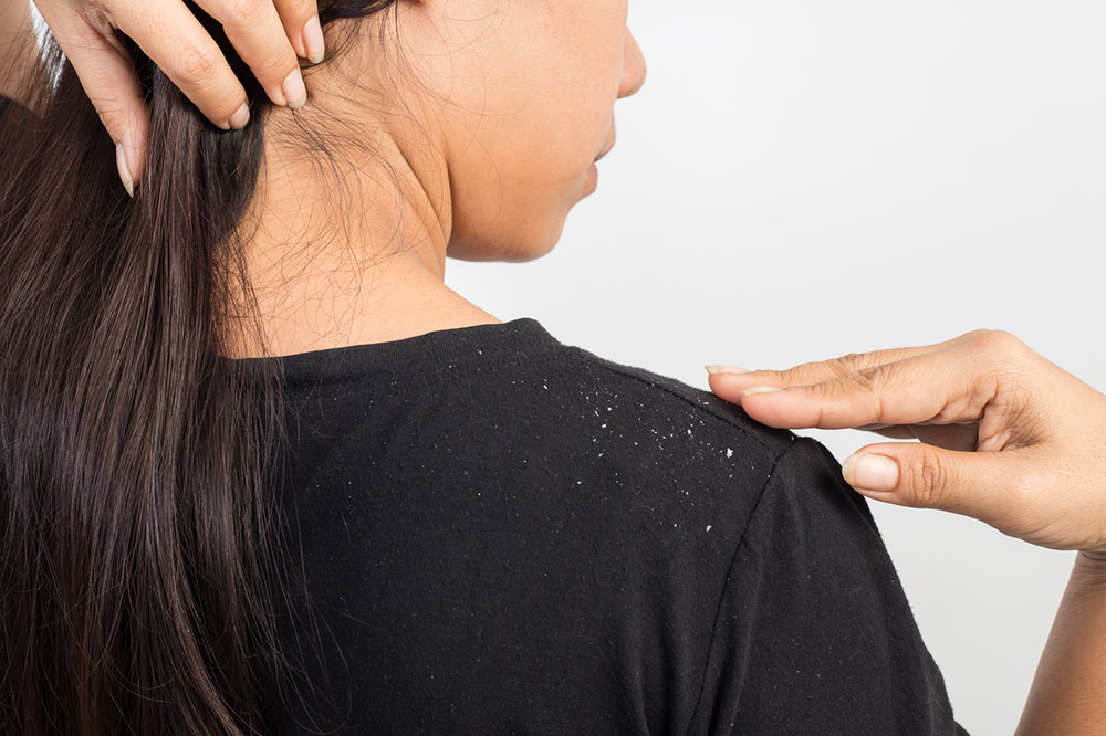 Natural Remedies To Fight Dandruff